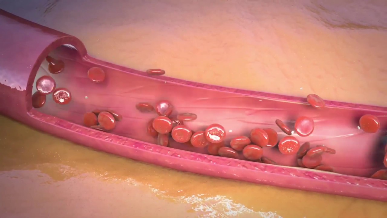 Which factors contribute to lasting results from shockwave for ED?